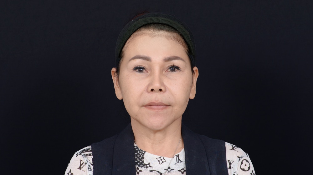 Results after VDERMA thread treatment